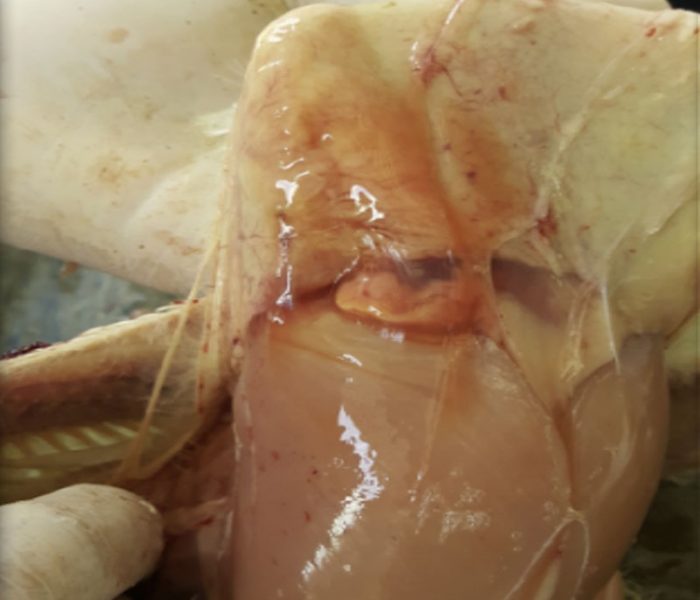 anemia_5